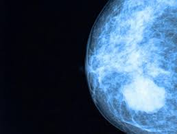 'Bomba inteligente' contra cáncer de mama 